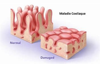 maladie cœliaque